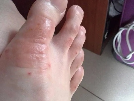 脚上起小水泡还很痒是怎么回事？一篇文章说清楚原因和应对方法